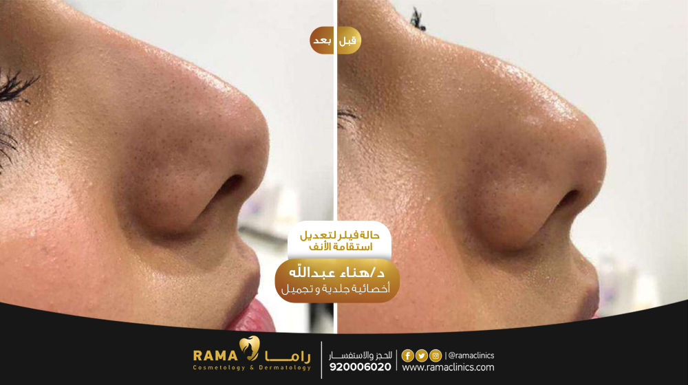 قبل العلاج