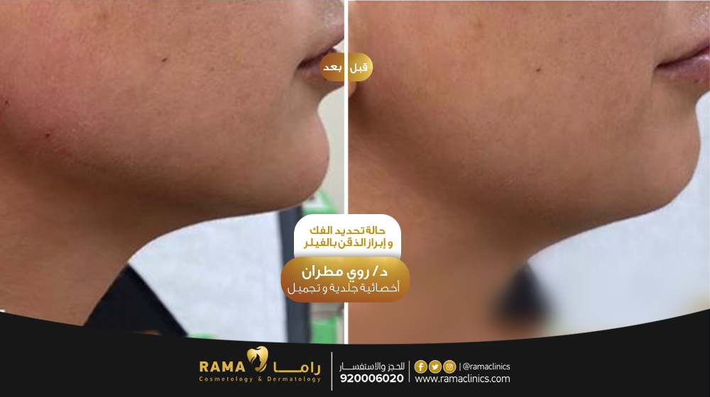 قبل العلاج