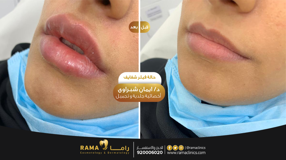 قبل العلاج